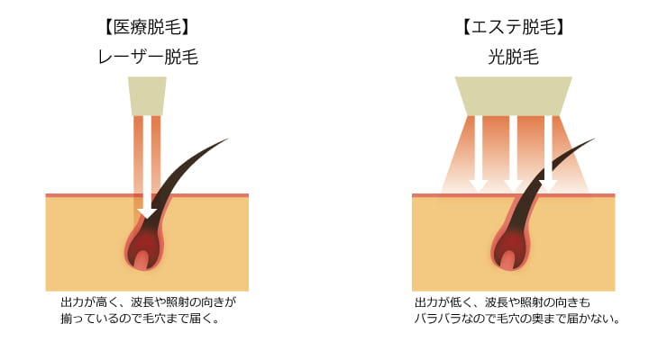 永久脱毛が可能