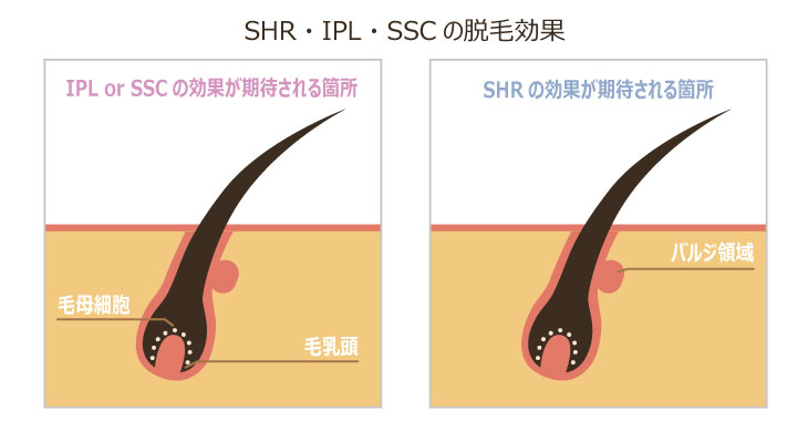 エステ脱毛で使用している脱毛機