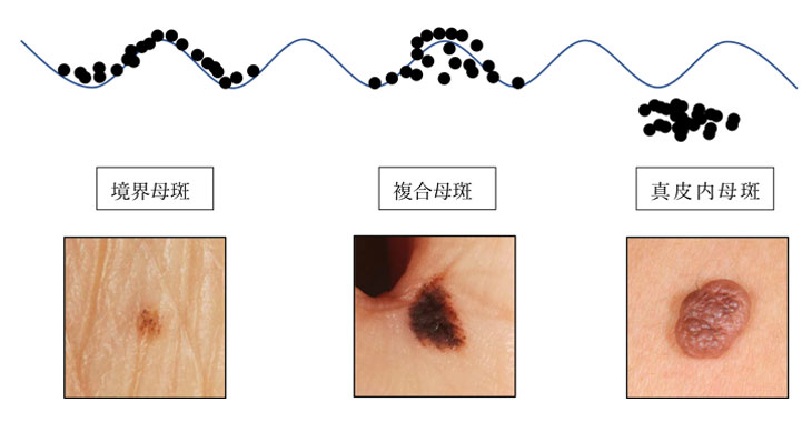 母斑細胞によるほくろの分類