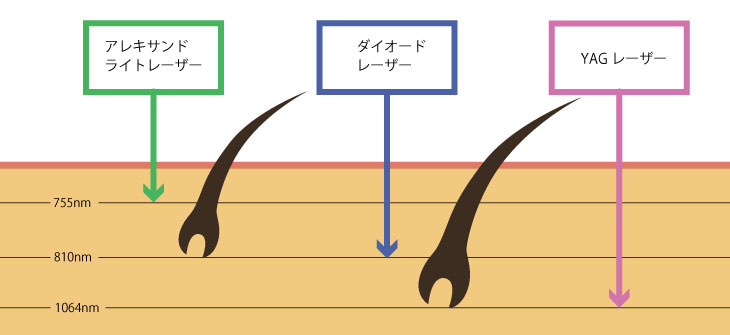 痛みが少ない