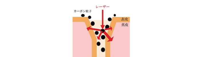 カーボンピーリングの仕組み