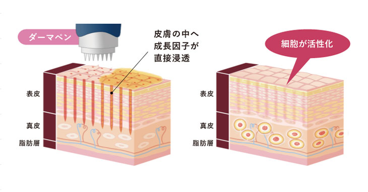 ダーマペンの仕組み