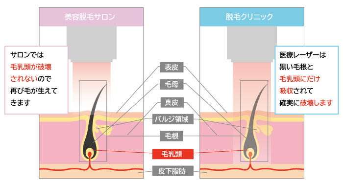 脱毛サロン・クリニック